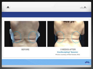 CoolSculpting® Before & After Photos