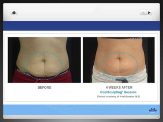 CoolSculpting® Before & After Photos