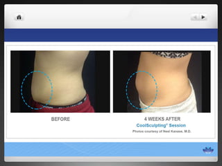 CoolSculpting® Before & After Photos