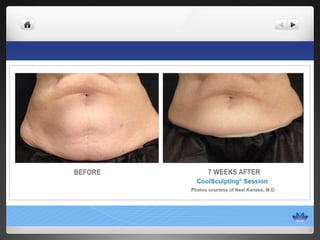 CoolSculpting® Before & After Photos