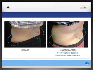 CoolSculpting® Before & After Photos