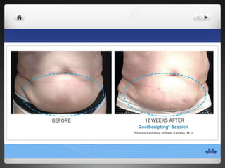 CoolSculpting® Before & After Photos