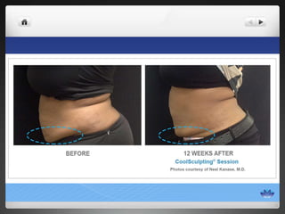 CoolSculpting® Before & After Photos
