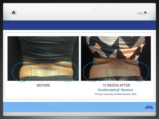 CoolSculpting® Before & After Photos