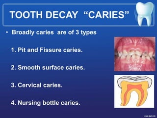 TOOTH DECAY “CARIES”
• Broadly caries are of 3 types
1. Pit and Fissure caries.
2. Smooth surface caries.
3. Cervical caries.
4. Nursing bottle caries.
 