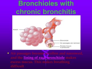 Bronchioles with chronic bronchitisAir passages become swollen and narrowed, and thelining of each bronchiolemakes excess mucus. This makes breathing difficult