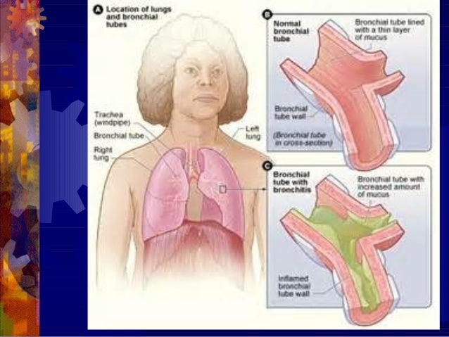 Copd Exacerbation Without Cough - Kronis h