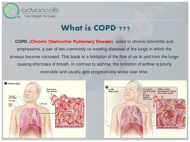 is copd hereditary