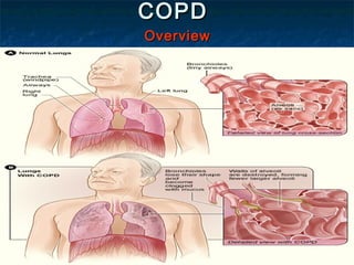COPDCOPD
OverviewOverview
 