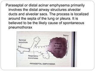 Paraseptal or distal acinar emphysema primarily
involves the distal airway structures alveolar
ducts and alveolar sacs. The process is localized
around the septa of the lung or pleura. It is
believed to be the likely cause of spontaneous
pneumothorax
 