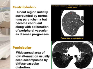 Centrilobular-
lucent region initially
surrounded by normal
lung parenchyma but
become confluent
along with obliteration
of peripheral vascular
as disease progresses.
Panlobular-
Widespread area of
low attenuation usually
seen accompanied by
diffuse vascular
distortion.
 