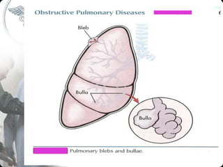 CHRONIC OBSTRUCTIVE PULMONARY DISEASE BY AKRAM KHAN