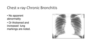 Chest x-ray-Chronic Bronchitis
• No apparent
abnormality
• Or thickened and
increased lung
markings are noted.
No apparent
abnormality
Or thickened and
increased lung
markings are noted.
 