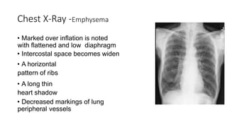 Chest X-Ray -Emphysema
• Marked over inflation is noted
with flattened and low diaphragm
• Intercostal space becomes widen
• A horizontal
pattern of ribs
• A long thin
heart shadow
• Decreased markings of lung
peripheral vessels
 