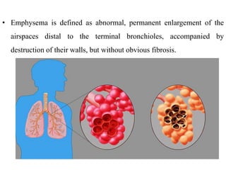 • Emphysema is defined as abnormal, permanent enlargement of the
airspaces distal to the terminal bronchioles, accompanied by
destruction of their walls, but without obvious fibrosis.
 