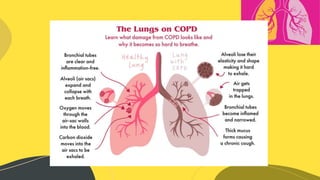 Copd | PPTX