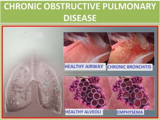 CHRONIC OBSTRUCTIVE PULMONARY
DISEASE
 