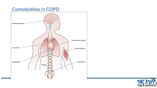 Comorbidities in COPD
 