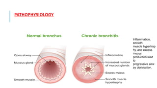 PATHOPHYSIOLOGY
Inflammation,
smooth
muscle hypertrop
hy, and excess
mucus
production lead
to
progressive airw
ay obstruction.
 