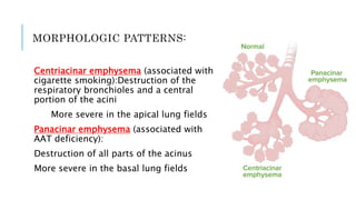 MORPHOLOGIC PATTERNS:
Centriacinar emphysema (associated with
cigarette smoking):Destruction of the
respiratory bronchioles and a central
portion of the acini
More severe in the apical lung fields
Panacinar emphysema (associated with
AAT deficiency):
Destruction of all parts of the acinus
More severe in the basal lung fields
 