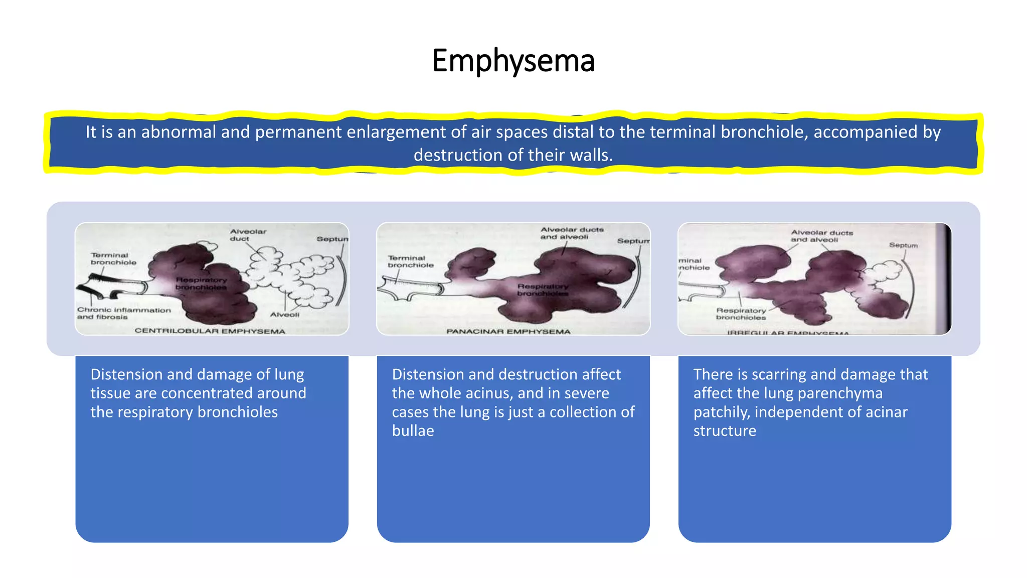 Emphysema
It is an abnormal and permanent enlargement of air spaces distal to the terminal bronchiole, accompanied by
destruction of their walls.
Distension and damage of lung
tissue are concentrated around
the respiratory bronchioles
Distension and destruction affect
the whole acinus, and in severe
cases the lung is just a collection of
bullae
There is scarring and damage that
affect the lung parenchyma
patchily, independent of acinar
structure
 