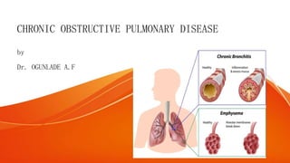 CHRONIC OBSTRUCTIVE PULMONARY DISEASE
by
Dr. OGUNLADE A.F
 