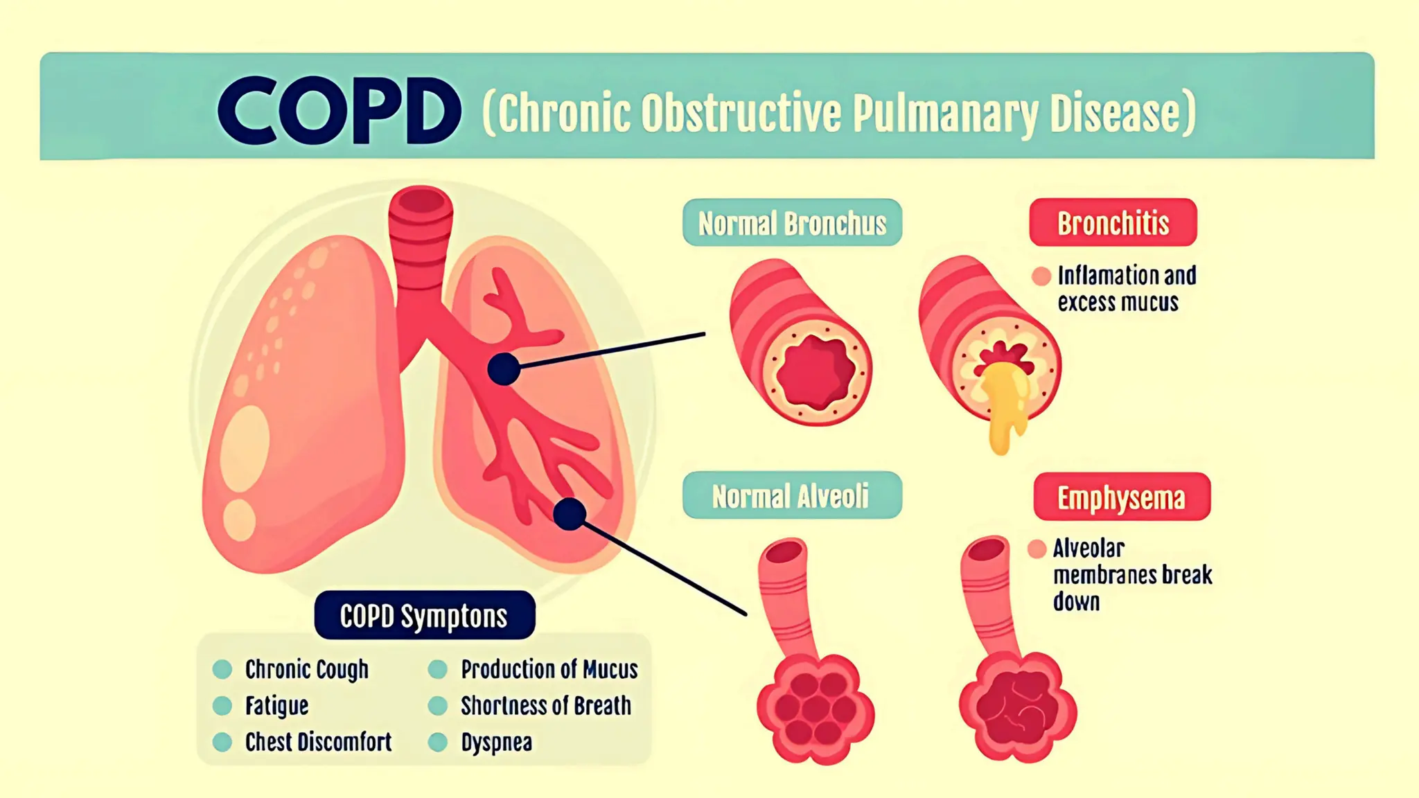 Copd Development COPD : Stages, Causes, Symptoms & Treatment | PDF