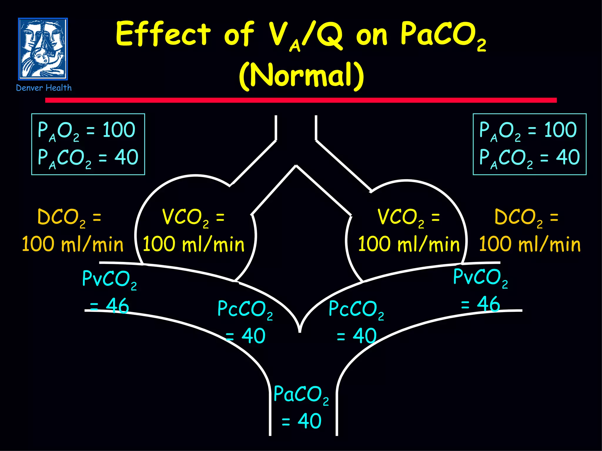 Effect of V A /Q on PaCO 2 (Normal) VCO 2  = 100 ml/min PcCO 2 = 40 PaCO 2 = 40 PcCO 2 = 40 PvCO 2 = 46 PvCO 2 = 46 DCO 2  =  100 ml/min DCO 2  =  100 ml/min P A O 2  = 100 P A CO 2  = 40 P A O 2  = 100 P A CO 2  = 40 VCO 2  = 100 ml/min Denver Health 