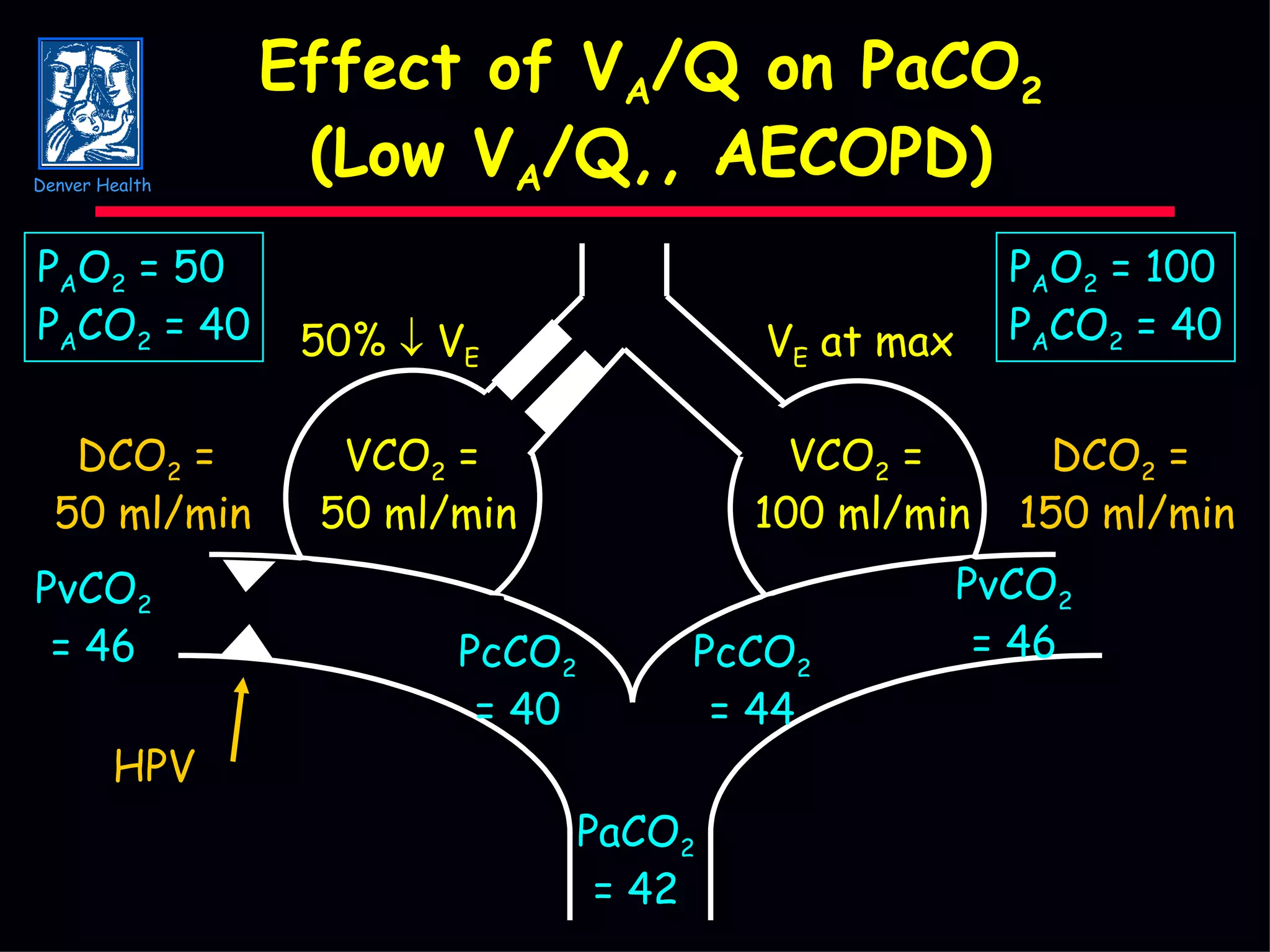 Effect of V A /Q on PaCO 2 (Low V A /Q,, AECOPD) PcCO 2 = 44 PaCO 2 = 42 PcCO 2 = 40 PvCO 2 = 46 PvCO 2 = 46 DCO 2  =  50 ml/min HPV V E  at max 50%    V E VCO 2  =  50 ml/min VCO 2  =  100 ml/min DCO 2  =  150 ml/min P A O 2  = 50 P A CO 2  = 40 P A O 2  = 100 P A CO 2  = 40 Denver Health 