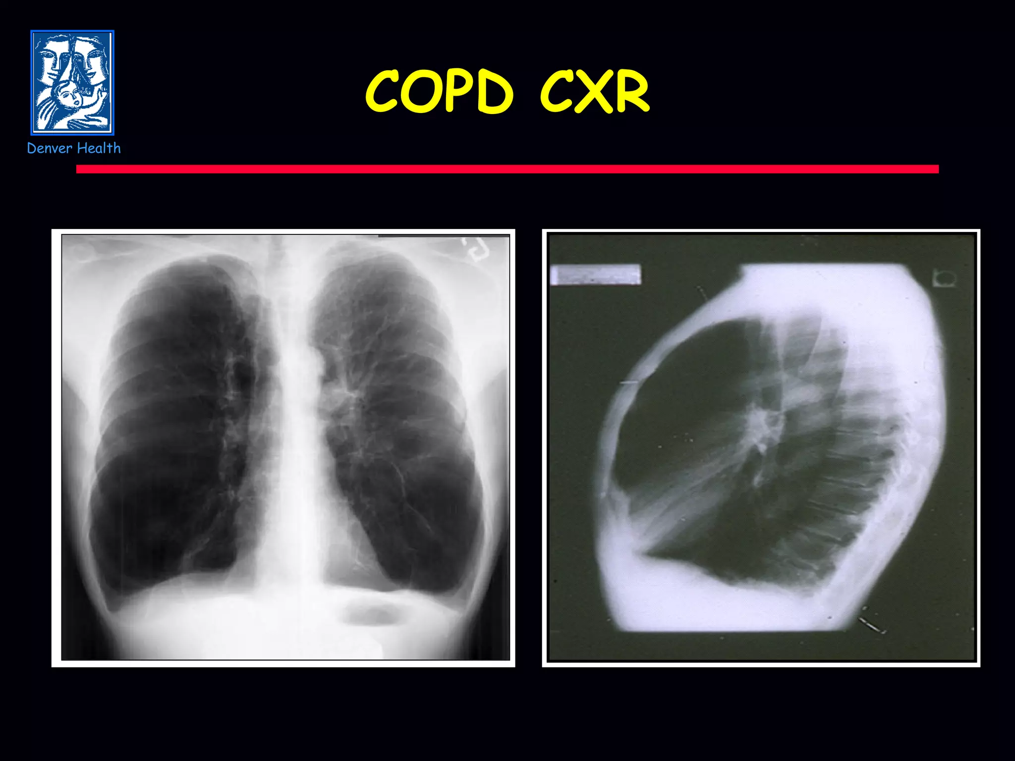 COPD CXR Denver Health 