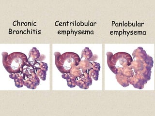 Chronic
Bronchitis
Centrilobular
emphysema
Panlobular
emphysema
 