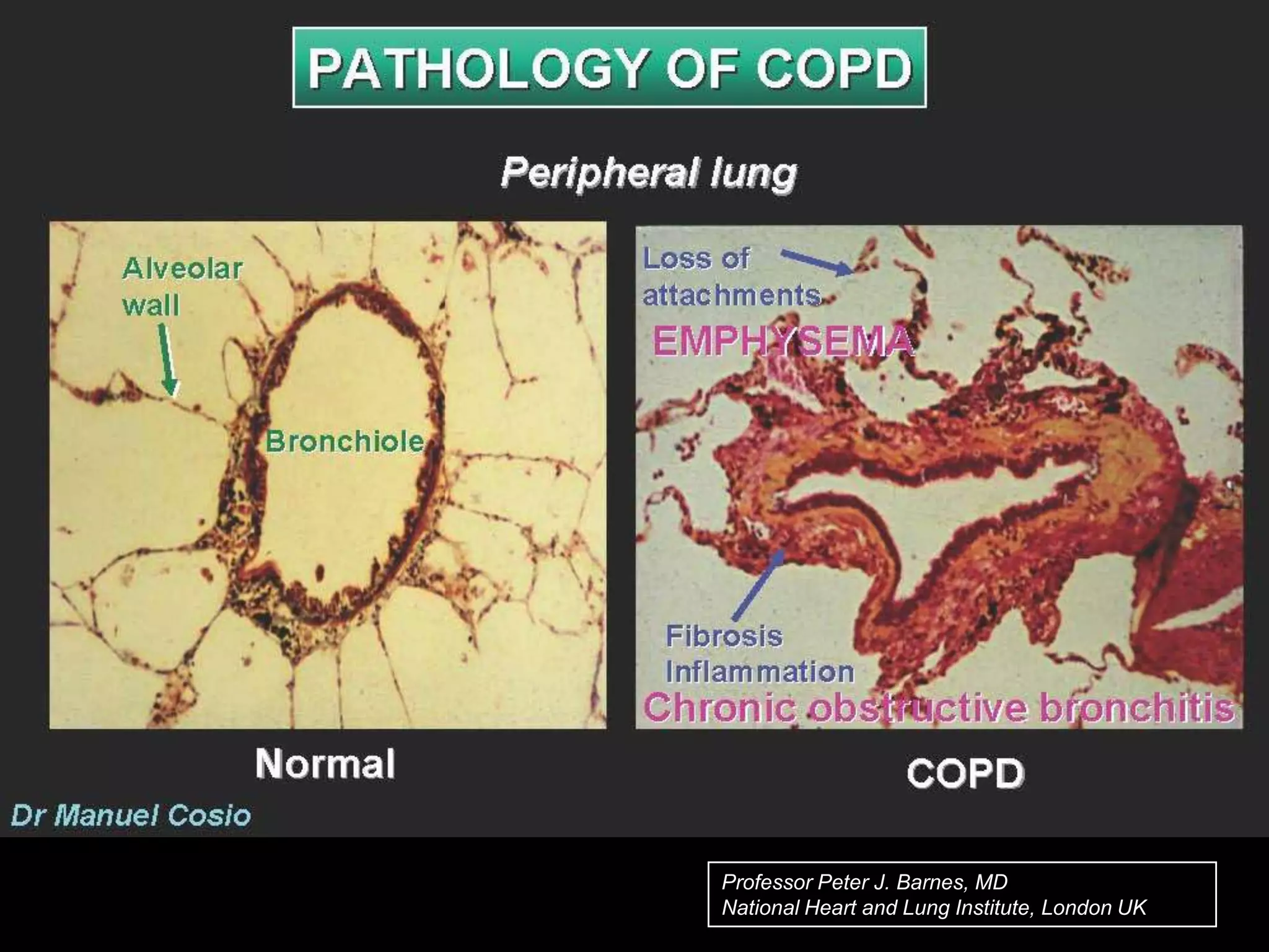 Chronic Obstructive Lung Disease | PPT