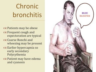 Patients may be obese
 Frequent cough and
expectoration are typical
 Coarse Ronchi and
wheezing may be present
 Earlier hypercapnia so
early secondary
Polycythemia
 Patient may have edema
and cyanosis
18
Chronic
bronchitis BLUE
BLOATER
 