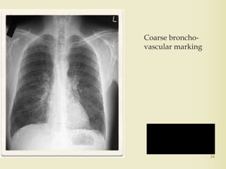 Coarse broncho-
vascular marking
24
Chronic
Bronchitis
 