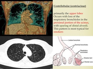 Centrilobular (centriacinar)
primarily the upper lobes
Occurs with loss of the
respiratory bronchioles in the
proximal portion of the acinus,
with sparing of distal alveoli.
This pattern is most typical for
smokers
25
 