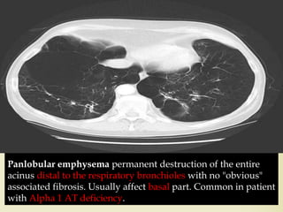 26
Panlobular emphysema permanent destruction of the entire
acinus distal to the respiratory bronchioles with no "obvious"
associated fibrosis. Usually affect basal part. Common in patient
with Alpha 1 AT deficiency.
 