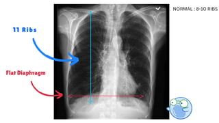 11 Ribs
Flat Diaphragm
NORMAL : 8-10 RIBS
 