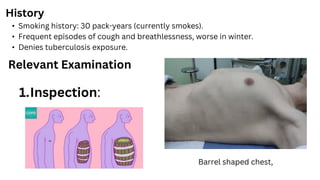 History
• Smoking history: 30 pack-years (currently smokes).
• Frequent episodes of cough and breathlessness, worse in winter.
• Denies tuberculosis exposure.
Relevant Examination
1.Inspection:
Barrel shaped chest,
 