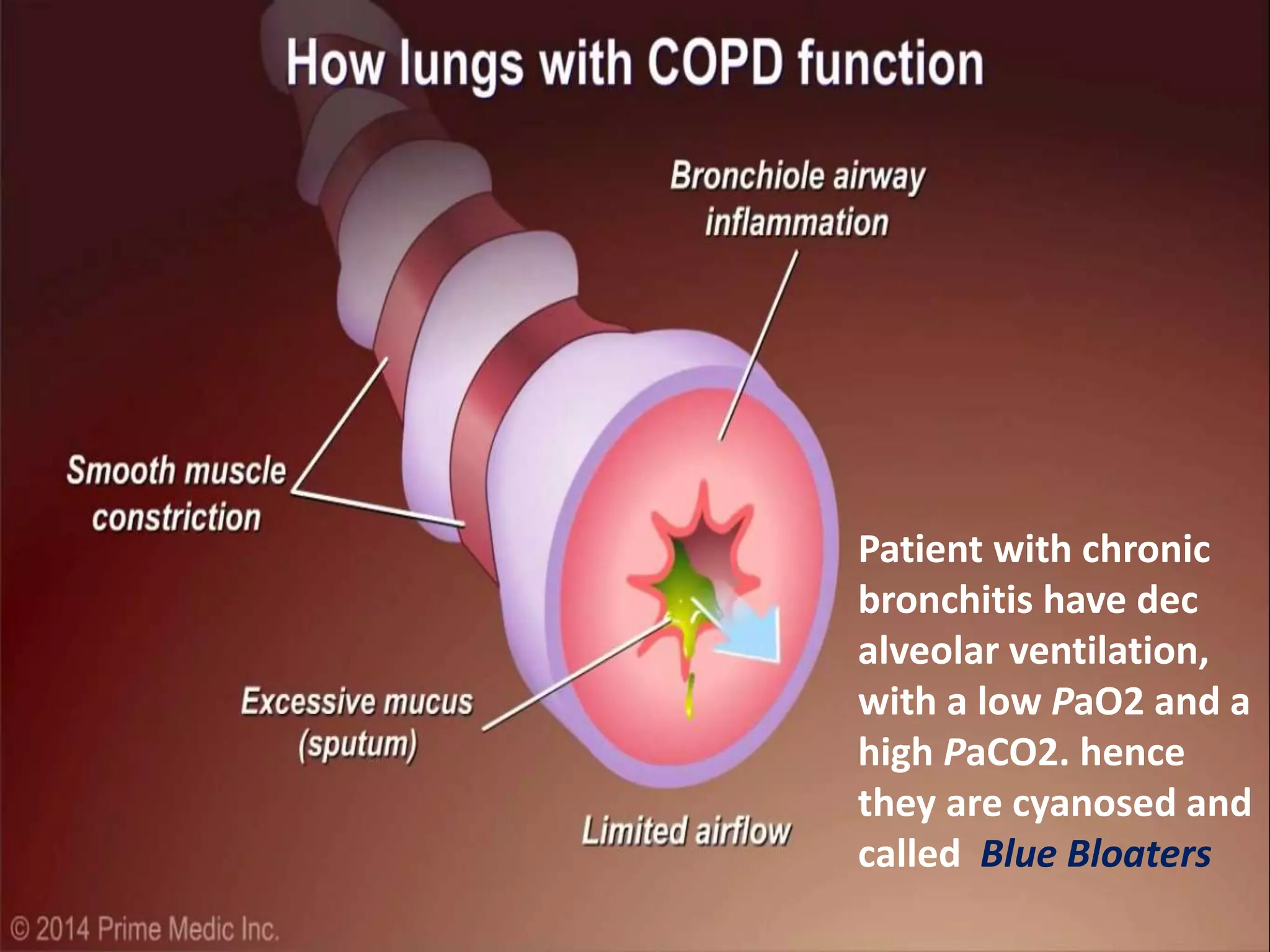 Patient with chronic
bronchitis have dec
alveolar ventilation,
with a low PaO2 and a
high PaCO2. hence
they are cyanosed and
called Blue Bloaters
 