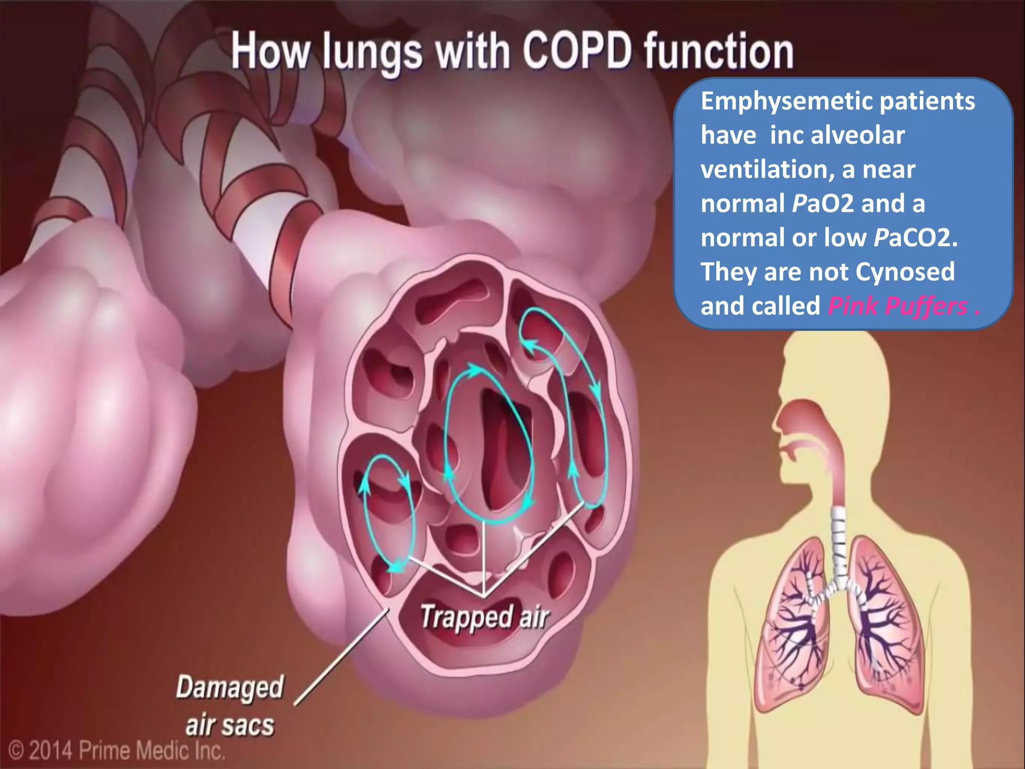 Emphysemetic patients
have inc alveolar
ventilation, a near
normal PaO2 and a
normal or low PaCO2.
They are not Cynosed
and called Pink Puffers .
 