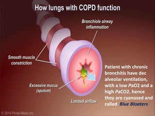 Patient with chronic
bronchitis have dec
alveolar ventilation,
with a low PaO2 and a
high PaCO2. hence
they are cyanosed and
called Blue Bloaters
 