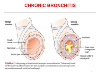 CHRONIC BRONCHITIS
12
 