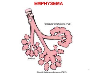 EMPHYSEMA
14
 
