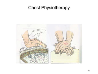 Chest Physiotherapy
30
 