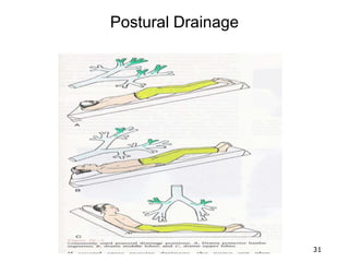 Postural Drainage
31
 
