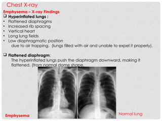 COPD-Chronic Obstructive Pulmonary Disease (COPD) | PPTX
