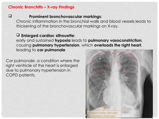 Bronkovascular Pattern COPD-Chronic Obstructive Pulmonary Disease (COPD) | PPTX