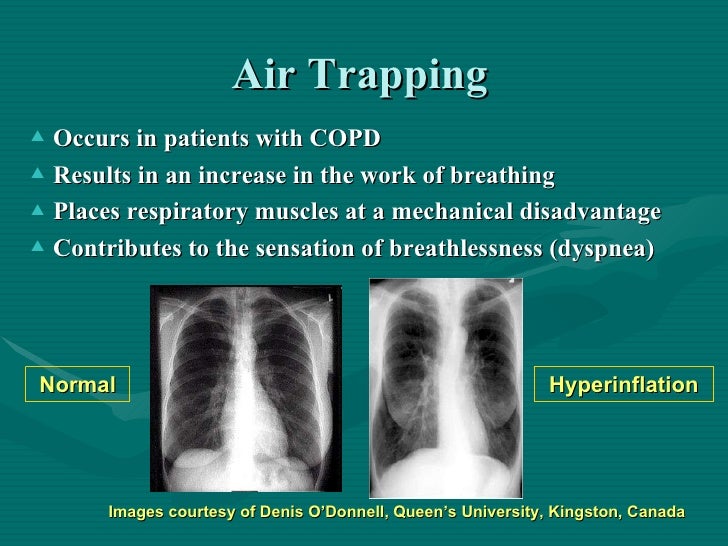 Copd(留学生2009)