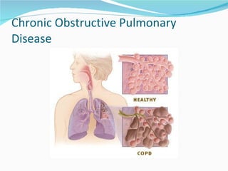 Chronic Obstructive Pulmonary Disease 