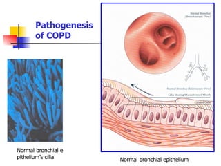 Normal bronchial e
pithelium’s cilia
Pathogenesis
of COPD
Normal bronchial epithelium
 